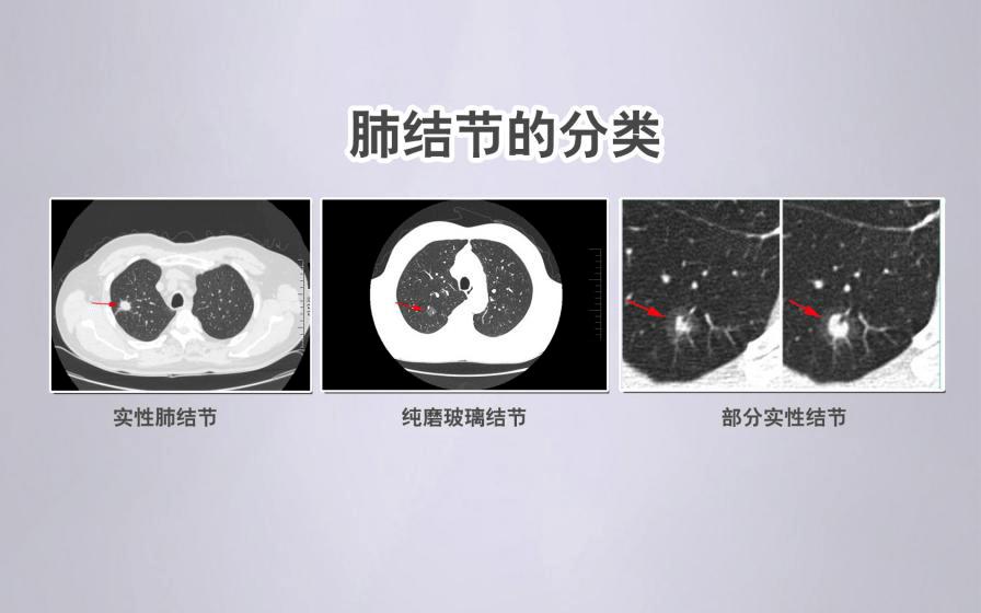 【合肥长淮中医医院】肺结节和肺癌什么关系? 【合肥长淮中医医院】肺结节和肺癌什么关系?